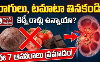 Foods to avoid for kidney stones – ragi, cashew, pomegranate, dark chocolate, tomato, peanuts, amaranth high oxalate foods.