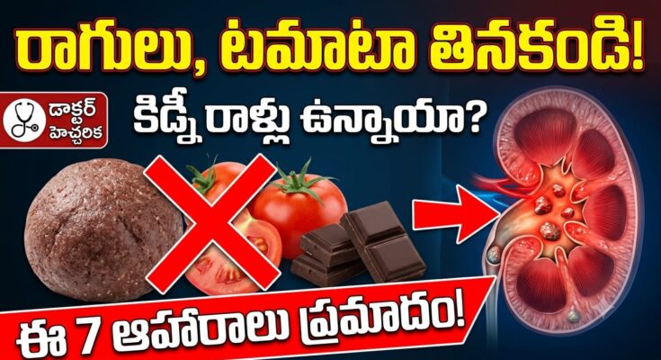 Foods to avoid for kidney stones – ragi, cashew, pomegranate, dark chocolate, tomato, peanuts, amaranth high oxalate foods.