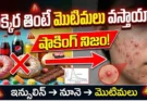 Sugar and Acne Connection: చక్కెర తింటే మొటిమలు వస్తాయా?