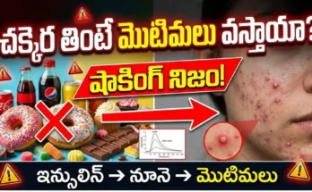 Sugar and acne connection – how sugary foods, insulin spikes, and inflammation cause pimples and affect skin health.