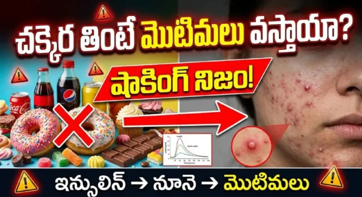 Sugar and acne connection – how sugary foods, insulin spikes, and inflammation cause pimples and affect skin health.